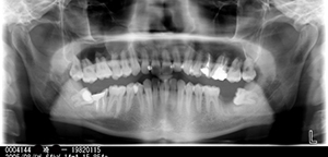 「ハリウッドスマイル8症例めの矯正歯科治療前のレントゲン」